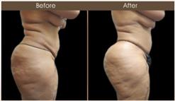 Before & After Gluteal Fat Transfer Treatment